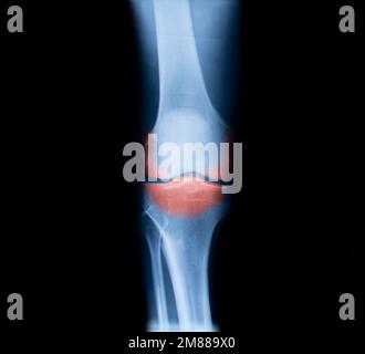 Radiografia con osteoartrite nel ginocchio Foto Stock