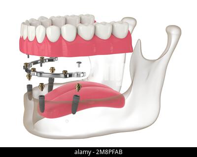 3d rappresentazione dell'installazione a asta rimovibile fissata supportata da impianti su bianco Foto Stock