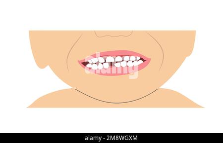 Il bambino sorride il dente mancante a causa del cambio dei denti del latte. Semplice illustrazione minimalistica della bocca del bambino con un set di denti incompleto. Illustrazione Vettoriale