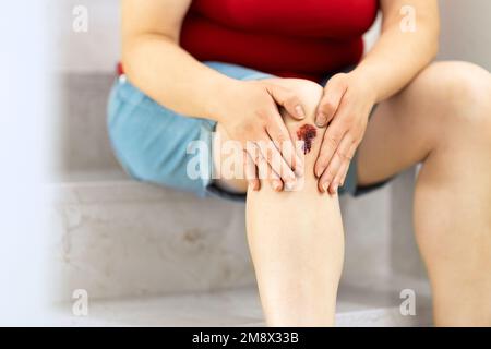Primo piano delle gambe di una donna che inciampa e guarda una ferita con il sangue che scende le scale Foto Stock
