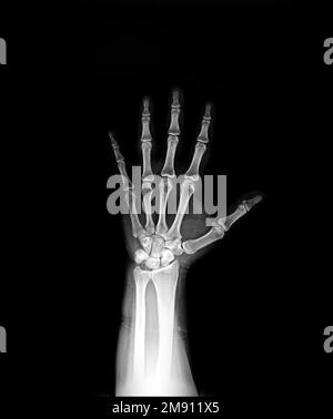 Vista AP mano radiologica normale Foto Stock