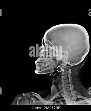 Radiografia vista laterale cranio Foto Stock