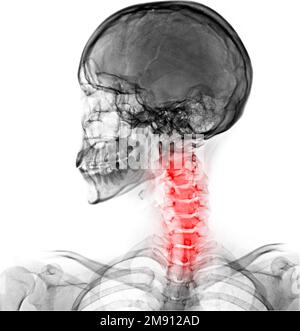 Dolore al collo . Filmare la vista laterale del cranio radiografico e la colonna cervicale . Foto Stock