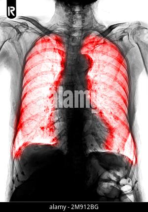 La radiografia toracica della pellicola mostra un'infiltrazione interstiziale di entrambi i polmoni Foto Stock