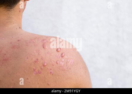 acne occipitale in un ragazzo adolescente guarito, cicatrici da acne adolescente sulle spalle, infezioni della pelle e allergie al corpo di un uomo, sanità e m. Foto Stock