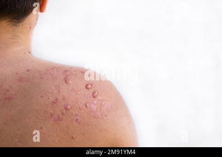 acne occipitale in un ragazzo adolescente guarito, cicatrici da acne adolescente sulle spalle, infezioni della pelle e allergie al corpo di un uomo, sanità e m. Foto Stock