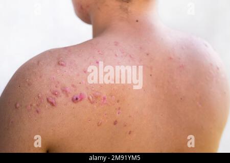 acne occipitale in un ragazzo adolescente guarito, cicatrici da acne adolescente sulle spalle, infezioni della pelle e allergie al corpo di un uomo, sanità e m. Foto Stock