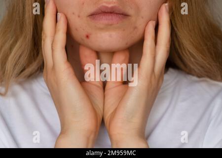 Donna irriconoscibile che mostra la sua acne sulla faccia. Acne di primo piano sul viso della donna con pelle rash, cicatrice e spot che allergico ai cosmetici. Problema Skincare e concetto di salute. Rughe, melasma, macchie scure, lentiggini, pelle secca, i blackheads dell'acne sulla faccia le donne di mezza età problema dell'acne del mento. pimples sulla pelle di problema di barba. in una ragazza giovane. il disequilibrio ormonale. I disturbi della pelle portano alla depressione e alle insicurezze nelle donne Foto Stock