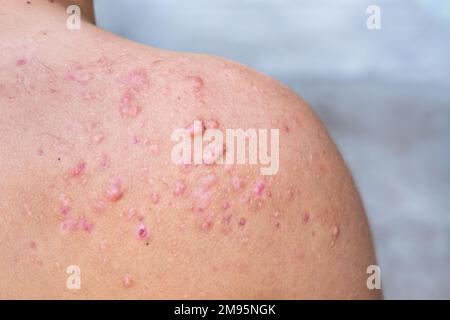 acne occipitale in un ragazzo adolescente guarito, cicatrici da acne adolescente sulle spalle, infezioni della pelle e allergie al corpo di un uomo, sanità e m. Foto Stock