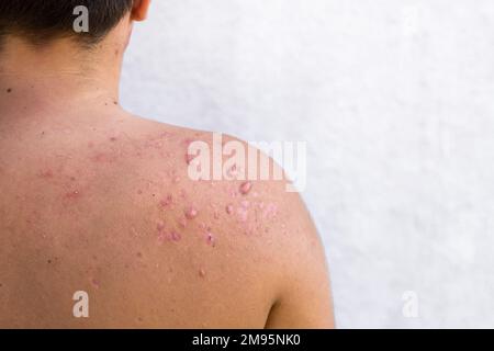 acne occipitale in un ragazzo adolescente guarito, cicatrici da acne adolescente sulle spalle, infezioni della pelle e allergie al corpo di un uomo, sanità e m. Foto Stock