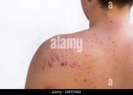 acne occipitale in un ragazzo adolescente guarito, cicatrici da acne adolescente sulle spalle, infezioni della pelle e allergie al corpo di un uomo, sanità e m. Foto Stock