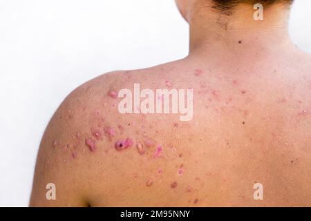 acne occipitale in un ragazzo adolescente guarito, cicatrici da acne adolescente sulle spalle, infezioni della pelle e allergie al corpo di un uomo, sanità e m. Foto Stock