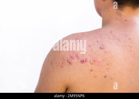 acne occipitale in un ragazzo adolescente guarito, cicatrici da acne adolescente sulle spalle, infezioni della pelle e allergie al corpo di un uomo, sanità e m. Foto Stock