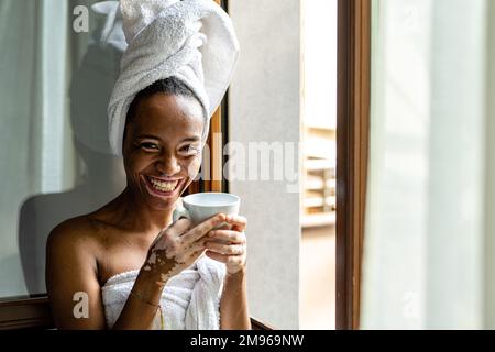 Ritratto di giovane donna brasiliana con Vitiligo su viso e mani, cura della pelle e concetto medico Foto Stock