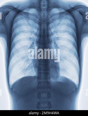 Immagine radiologica toracica per diagnosi di screening TB,tuberculosis e covid-19. Foto Stock