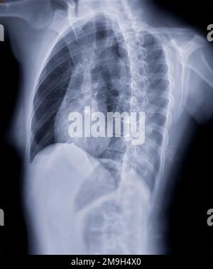 Vista obliqua dell'immagine radiografica del torace per la diagnosi di screening TB, tuberculosis e COVID-19. Foto Stock