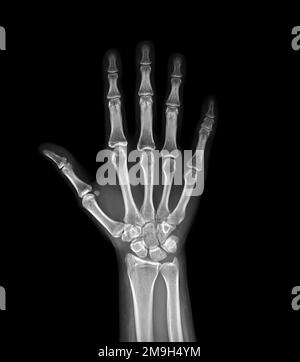 Immagine radiografica della vista AP a entrambe le mani isolata su sfondo nero per la diagnosi reumatoide. Foto Stock