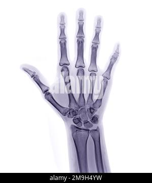 Immagine radiografica della vista AP di entrambe le mani isolata su sfondo bianco per reumatoide diagnostico. Foto Stock