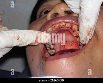 040514-M-4688C-005. Un giovane paziente thailandese ha avuto due denti estratti da US Navy (USN) Lieutenant (LT) Steven H. Bailey, dentista, US Marine Corps (USMC) Marine Expeditionary Unit (MEU) Service Support Group 31 (MSSG-31), 31st MEU SOC (Special Operations Capable), Anfibio Squadron 11 (PHIBRON 11), Essex Ready Group (ARbious Ready), Anfibio All'interno della clinica medica temporanea allestita presso una scuola elementare Ban Khok Wat, Thailandia. Il MSSG-31 sta lavorando con Royal Thai Marine Corps (RTMC) Marines in un progetto combinato di assistenza medica/dentale della Comunità (Med/Den CAP) fornendo assistenza medica e dentale a. Foto Stock