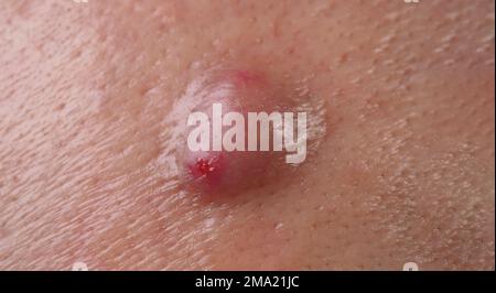 Infezione batterica della pelle. Ascesso o ulcera di cisti grandi all'interno del tessuto cutaneo del viso. Contenente accumulo di pus e sangue. Immagine macro di Foto Stock