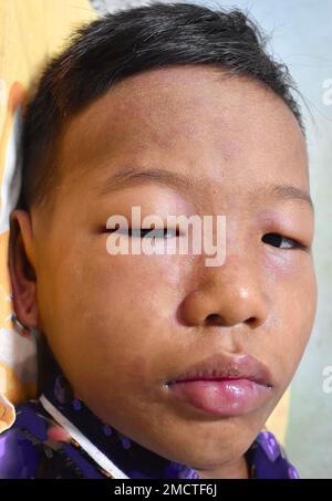 Angioedema alle palpebre e alle labbra del bambino maschio del sud-est asiatico. Bambino edematoso. Causato da droga, frutti di mare o allergia chimica e morso di insetto. Foto Stock