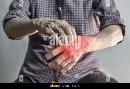 Donna anziana asiatica che graffia la mano. Concetto di malattie della pelle pruriginose come scabbia, infezione fungina, eczema, psoriasi, eruzione cutanea, allergia, ecc. Foto Stock