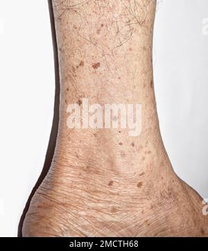 Macchie di età sulla gamba dell'uomo anziano asiatico. Sono macchie marroni, grigie o nere e anche chiamate macchie di fegato, lentigo senile, lentigine solari, o sp. Sole Foto Stock