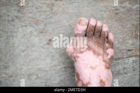 La gamba del vecchio con la condizione della pelle che causa la perdita di melanina in posa all'interno. Il modello piede e dito in nero canotta top che soffrono di vitiligine Foto Stock