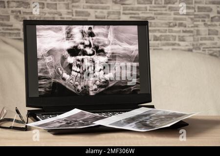 Raggi X panoramici dei denti dei bambini di due mascelle, ortopantomogramma dei denti dei bambini sugli schermi dei computer portatili sul tavolo Foto Stock