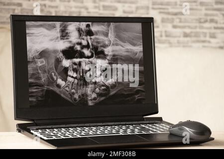 Raggi X panoramici dei denti dei bambini di due mascelle, ortopantomogramma dei denti dei bambini sugli schermi dei computer portatili sul tavolo Foto Stock