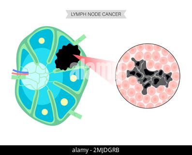 Linfoma, illustrazione concettuale Foto Stock