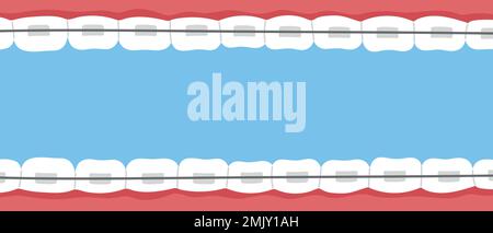 Banner denti rinforzati. Problema ortodontico, sorriso con staffe, fermo. Illustrazione con isolamento vettoriale piatto Illustrazione Vettoriale