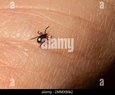 Encefalite infettiva Ixodes Scapularis o Persulcatus Deer Tick Insect sulla pelle. Encefalite virus o malattia di Lyme borreliosi infetta Ixodes Tick Foto Stock