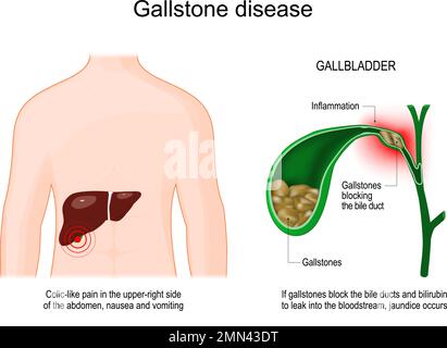 malattia di gallstone. Corpo umano con fegato. Sezione trasversale della cistifellea con pietre galliche che blocca un dotto biliare. Sintomi di colelitiasi Illustrazione Vettoriale