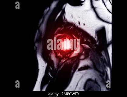 MRI Heart o Cardiac MRI (MRI cardiaca) nella vista dell'asse corto che mostra sezioni trasversali del ventricolo sinistro e destro per la diagnosi di cardiopatia. Foto Stock