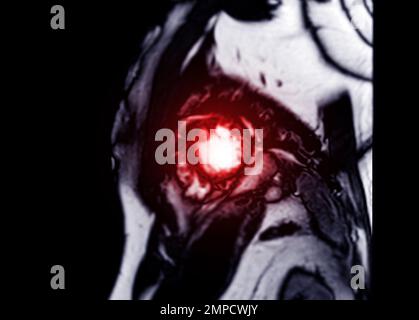 MRI Heart o Cardiac MRI (MRI cardiaca) nella vista dell'asse corto che mostra sezioni trasversali del ventricolo sinistro e destro per la diagnosi di cardiopatia. Foto Stock