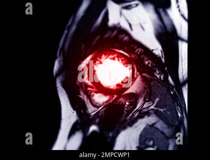 MRI Heart o Cardiac MRI (MRI cardiaca) nella vista dell'asse corto che mostra sezioni trasversali del ventricolo sinistro e destro per la diagnosi di cardiopatia. Foto Stock