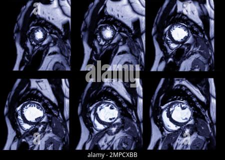 MRI Heart o Cardiac MRI (MRI cardiaca) nella vista dell'asse corto che mostra sezioni trasversali del ventricolo sinistro e destro per la diagnosi di cardiopatia. Foto Stock