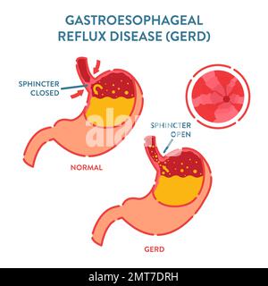 Malattia gastrica GERD rilevata mediante procedura endoscopica Illustrazione Vettoriale
