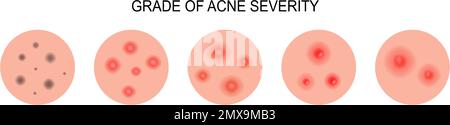 Grado di severità dell'acne. Diagramma medico acne di tipi diversi. Blackheads, whiteheads, papule, pustules, cystic e nodular. Illustrazione Vettoriale