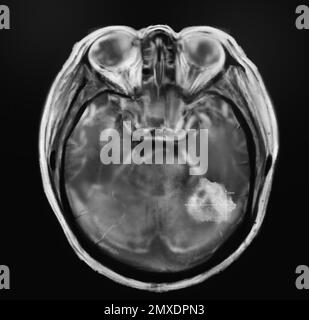 Radiografia di paziente con cancro al cervello. Illustrazione Foto Stock