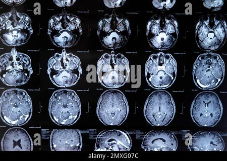 rm con tumore cerebrale. Imaging a risonanza magnetica. Foto Stock