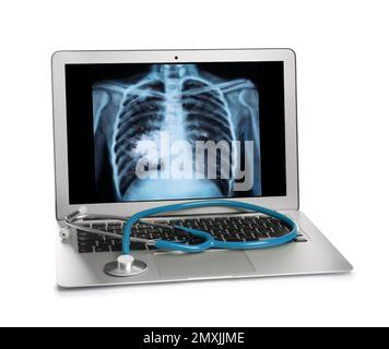 Notebook con radiografia di pazienti affetti da cancro polmonare su sfondo bianco Foto Stock