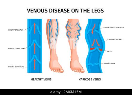 Malattia venosa delle gambe schema infografico del flusso sanguigno in vene sane e varicose rappresentazione vettoriale realistica Illustrazione Vettoriale