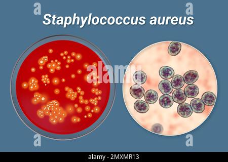 Batteri dello Staphylococcus aureus, illustrazione Foto Stock