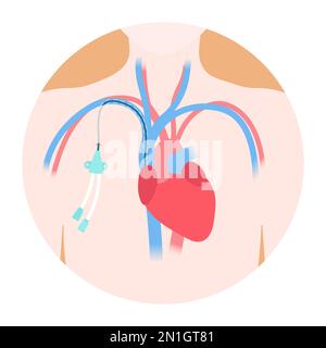 Diagramma medico del catetere venoso della linea centrale con tunnel Illustrazione Vettoriale