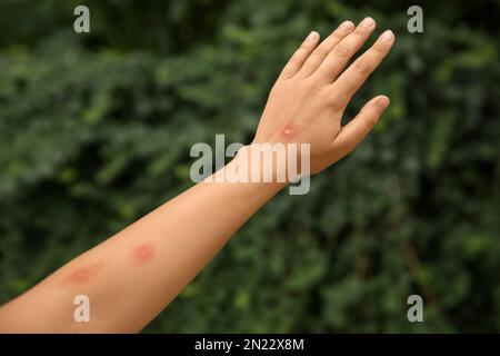 Donna con punture di insetto sul braccio nel parco, primo piano Foto Stock