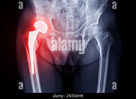 Radiografia della vista ap dell'anca che mostra la sostituzione dell'anca destra o la protesi dell'anca in titanio. Foto Stock