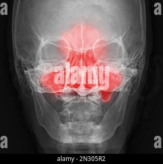 immagine radiografica dei seni paranasali per diagnosi sinusite. Foto Stock