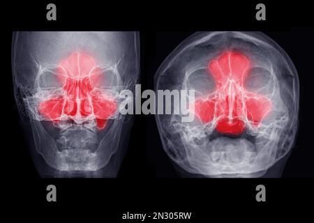 Immagine radiografica dei seni paranasali AP e vista dell'acqua per diagnosi sinusite. Foto Stock